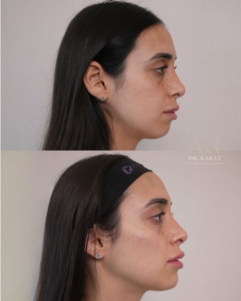 פיסול עצמות לחיים קו לסת